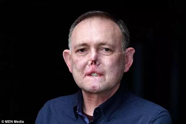 一个被狗抓伤的小伤口竟让他毁容又截肢,生命