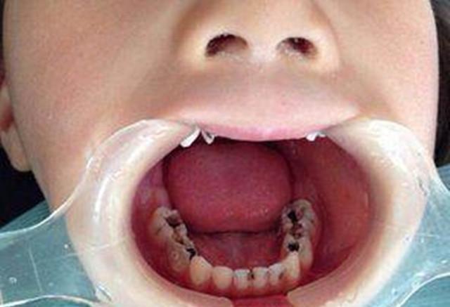 3岁娃从来不吃糖, 反而一口坏牙, 检查后家长自责!