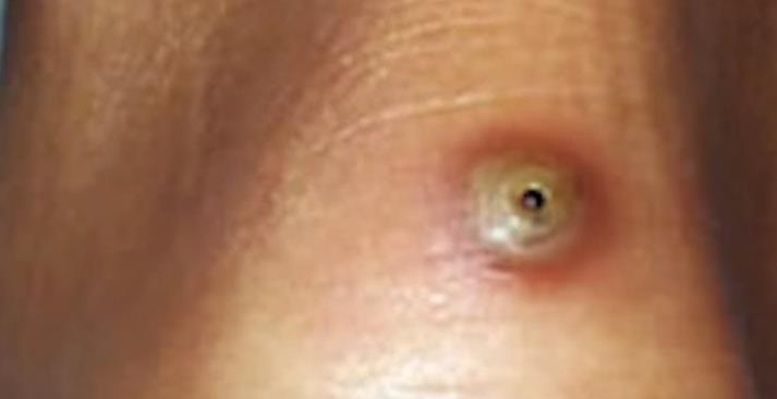 男子脚上发现黑点,回家后疼痛难忍,医生取出一