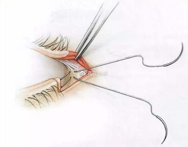 除双眼皮和内眼角手术,你知道开外眼角可以让