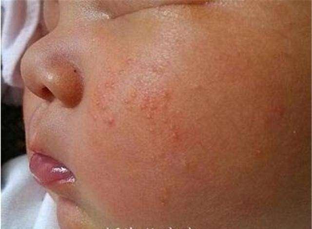 这四种宝宝常见皮肤病, 别在傻傻的分不清当成湿疹了