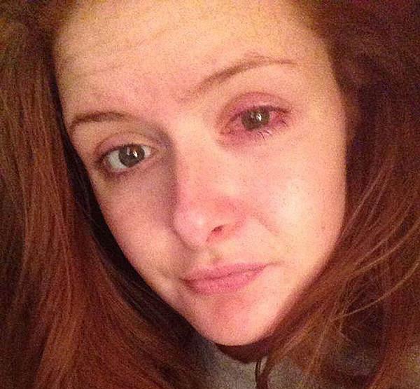 女孩16岁开始戴隐形眼镜, 7年后眼睛差点失明