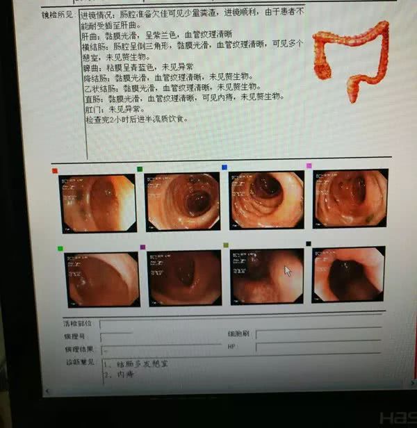 10分钟肠镜检查 扫除了一夜担心 查出一颗内痔!