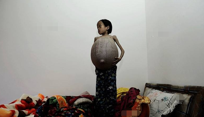 10岁女孩因为肚子大如气球医院检查后父母泪崩