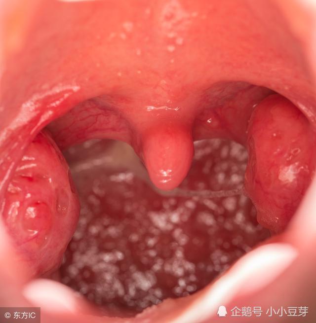 一般正常的扁桃体结石无什么大的伤害.