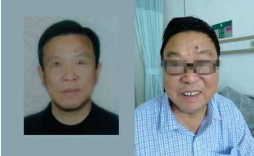 近三年吃了上百支"皮炎平"药膏,67岁的老伯长出"满月脸"