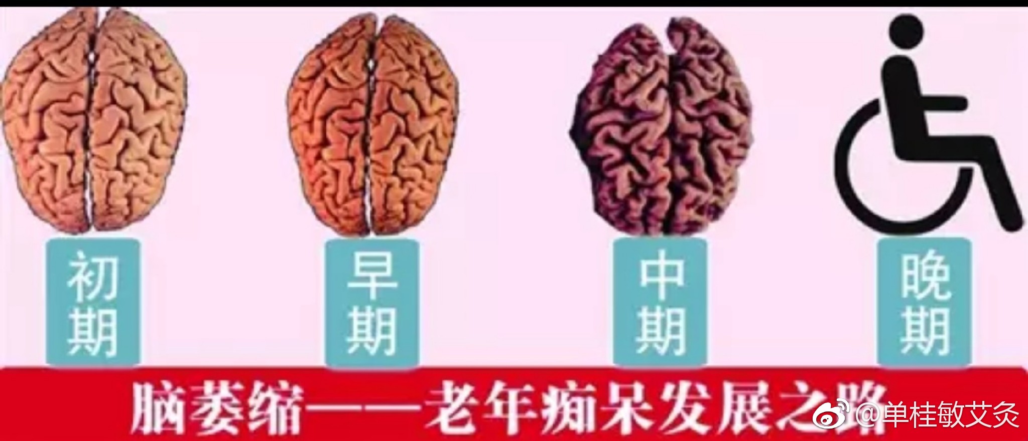 脑萎缩是老年痴呆的发展过程