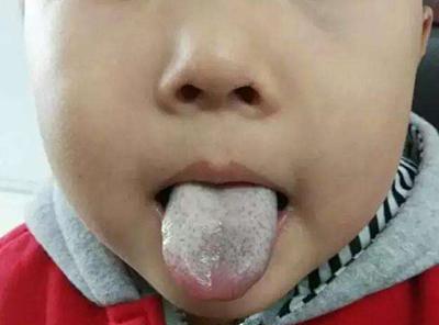 孩子舌苔变厚了, 用棉签蘸温水清洗了一下, 第二