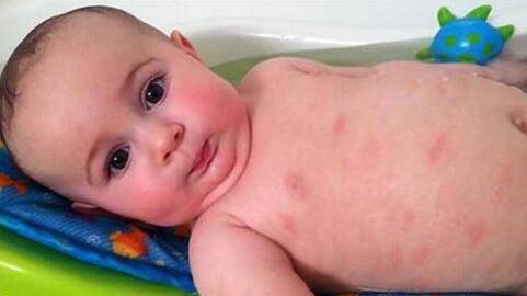 这些食物容易引起宝宝皮肤过敏! 宝宝过敏有什么症状?