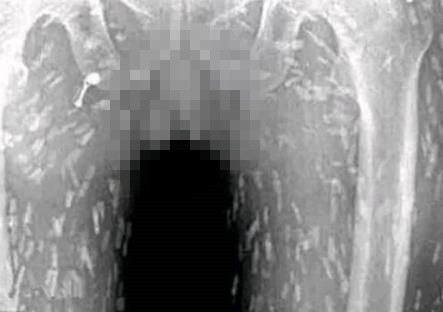 女子突然浑身难受,去医院拍片子,看到片子后吓