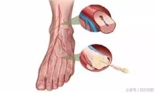 有一种病叫间歇性跛行 疼的是腿,病的是腰!