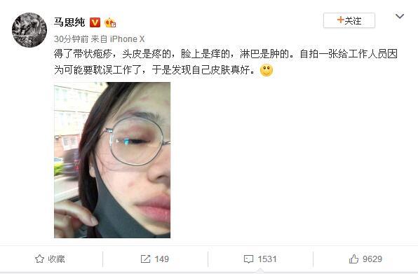 带状疱疹是不是性病