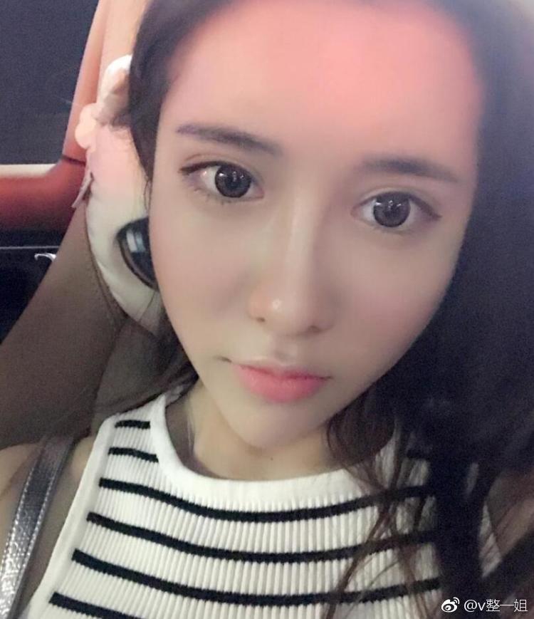 青岛隆鼻手术案例分享,做的事鼻综合修复,术后