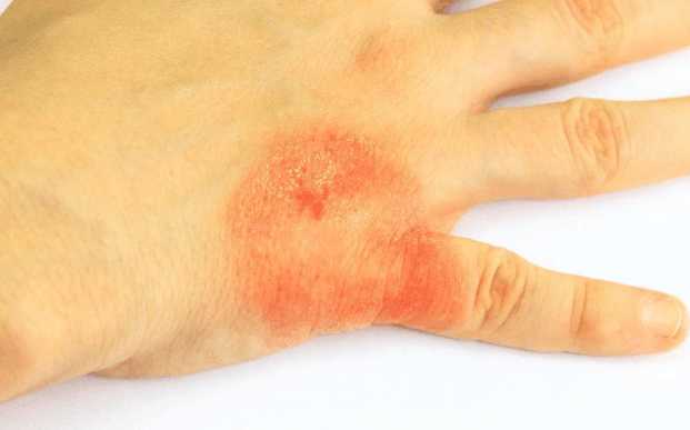 你对青霉素的了解有多少? 不适合用的人切记不