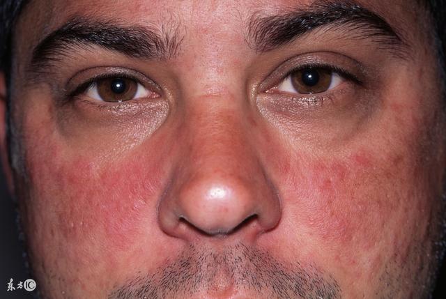 皮肤总是反复过敏,红肿痒结黄痂脱皮该怎么办