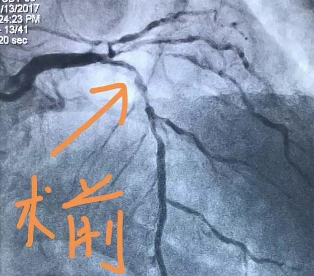 冠脉造影下血管堵塞情况