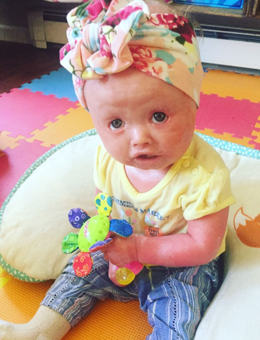 女婴患罕见病每天要花4个小时洗澡,医生称