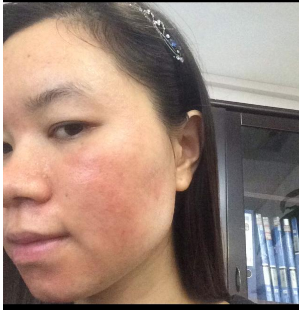 皮肤总是反复过敏,红肿痒结黄痂脱皮该怎么办