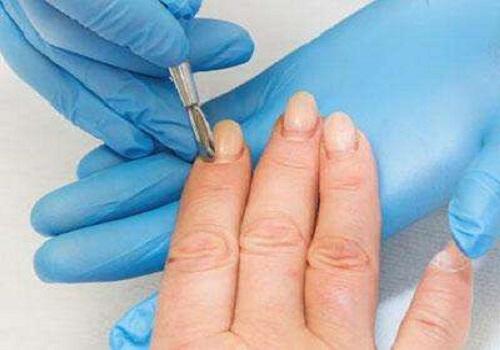 三种用于灰指甲的外用抗真菌药