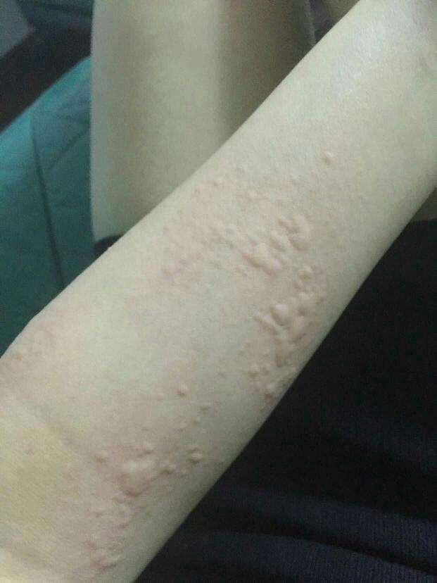 家中的好方子,每天用来抹一抹,止痒嫩肤,治好荨麻疹