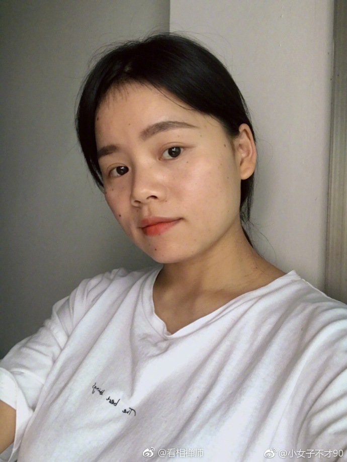 脸上痣多,俗称痣多星痣也病也,痣是体内毒素