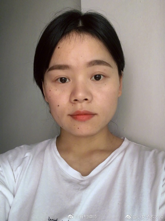 脸上痣多,俗称痣多星痣也病也,痣是体内毒素