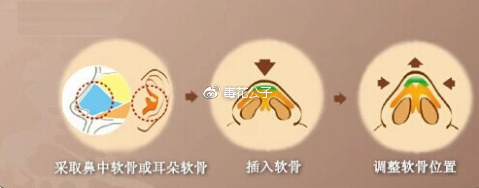 最强整理,关于硅胶隆鼻、膨体、自体软骨和玻尿酸怎么选?