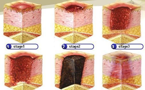 预防压疮!为皮肤护理打call…