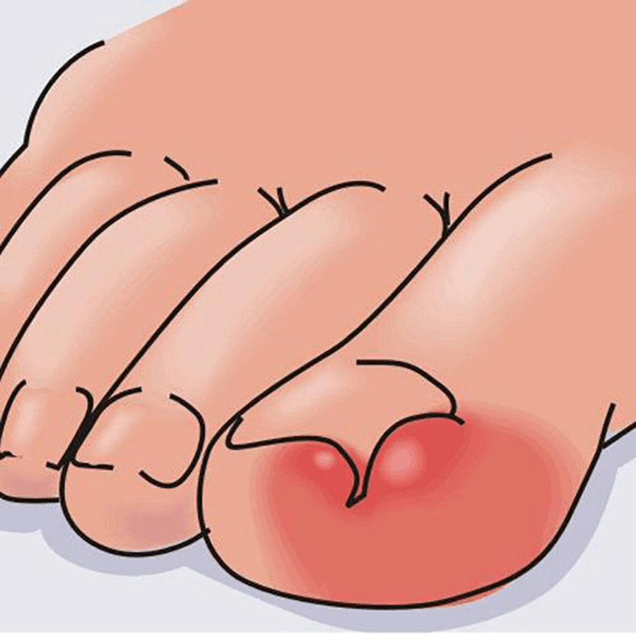 脚趾甲长肉里(甲沟炎)是否一定要拔甲