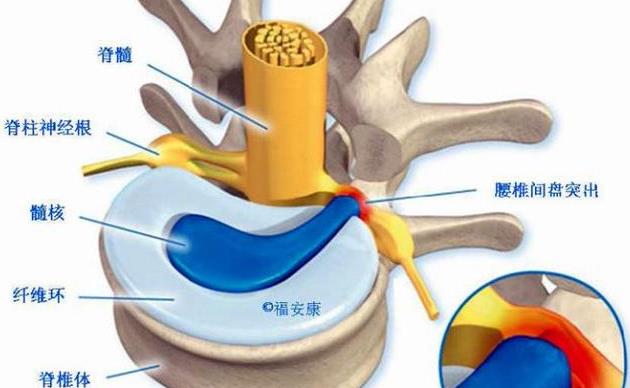 3,腹压增高激发腰椎间盘凸起,腹压与推间盘凸起有一定的干系,偶然