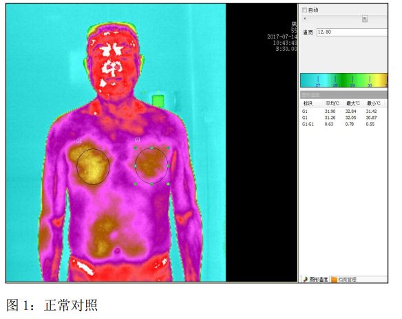《红外热成像技术筛查冠心病的临床探讨》登入《中医临床研究》