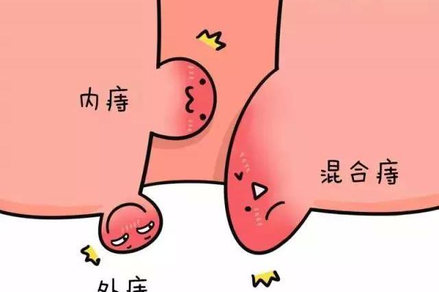 一篇关于痔疮的靠谱科普