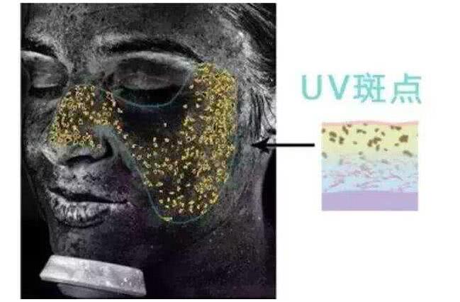 黄褐斑是肝病?别盲信皮肤科医生了,听听业余皮肤研究者怎么说!