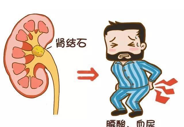 漫画告诉你肾结石是怎样形成的以及如何预防?