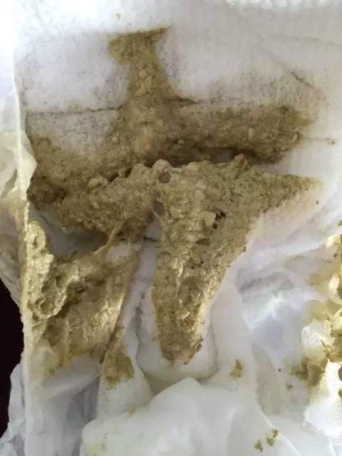 注意:如果宝宝便便一直是白色或陶土色,很有可能宝宝有胆道梗阻,应该