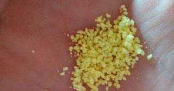 3岁孩子被劝退学只因口臭无比, 医生从他嗓子