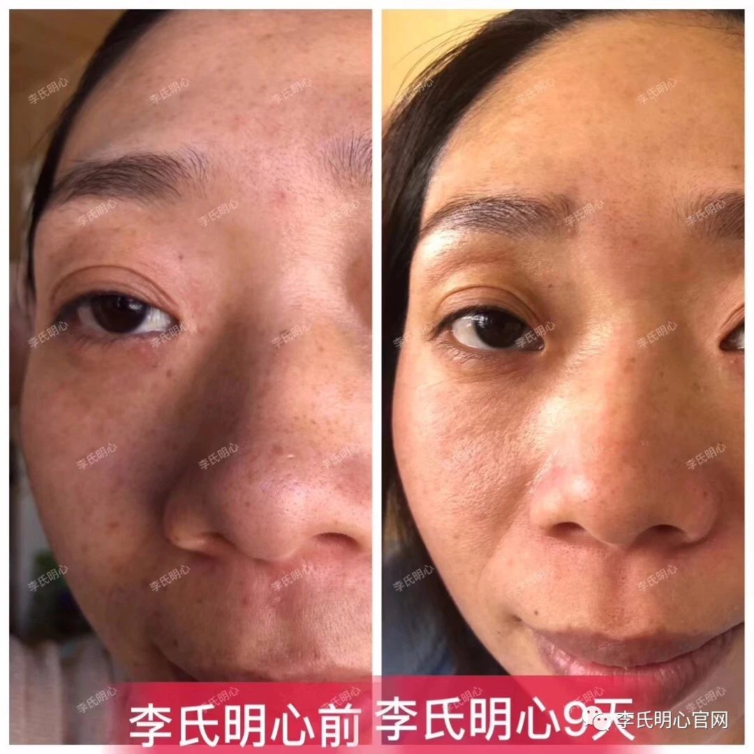 李氏明心祛斑用了我的脸彻底.