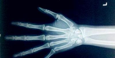 小孩子被检查出骨龄超过1.5岁, 妈妈疑惑为什么