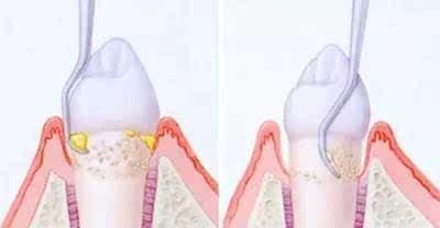 说说龈下刮治与洗牙,它们之间的区别