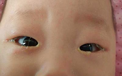 孩子嘴角有白茬, 大便干硬, 老中医食疗小方子