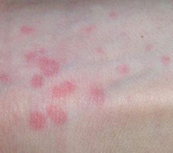 引起荨麻疹的过敏源有哪些