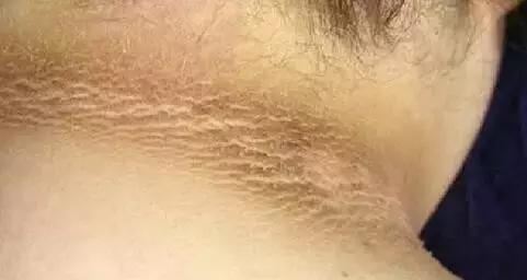 脖子后面黑黑的还洗不掉, 是怎么回事?