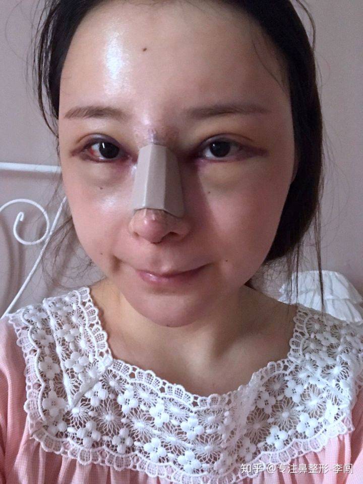 驼峰鼻矫正后,你的鼻子也能变得女性秀气精致