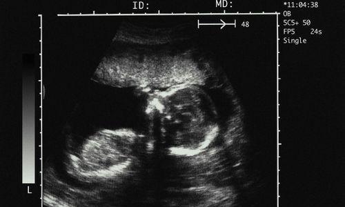 准确率90%!看B超识别胎儿性别,几个小办法教