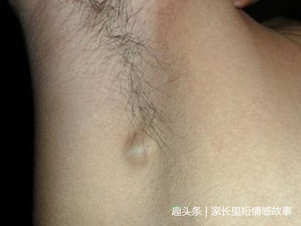 女子腋下长硬块,流出白色异物,医生说了三个字,吓哭女子.