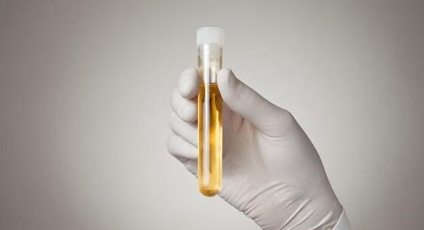 尿液有泡沫就是蛋白尿?当然不是,还要留意观察