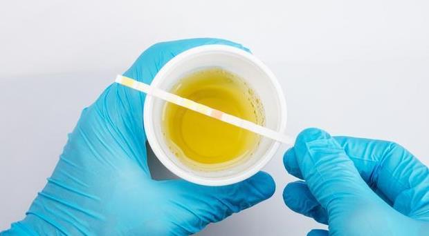 尿液有泡沫就是蛋白尿?当然不是,还要留意观察