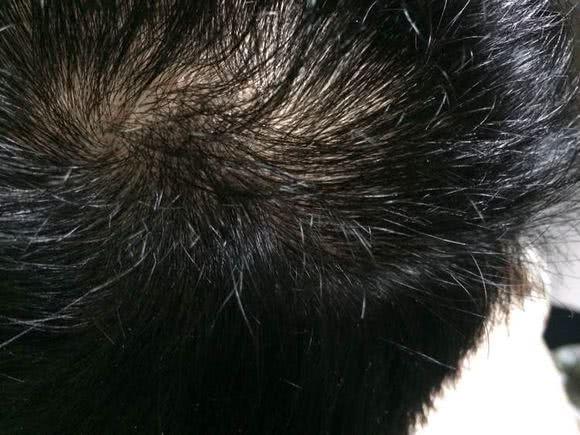 头上出现螨虫,4个症状会很明显,是头发在向你