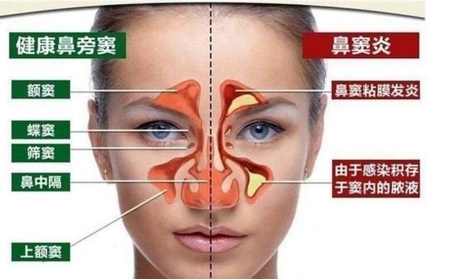 鼻炎一到冬天就犯,鼻子不通气很难受,有没 鼻炎冬天鼻子通气五官科