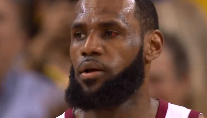 眼睛被戳伤的詹姆斯面临巨大风险 再遭撞击或